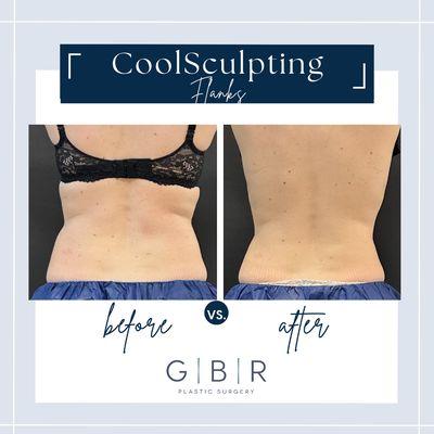 CoolSculpting in Virginia Beach