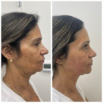 Non-Invasive Facelift