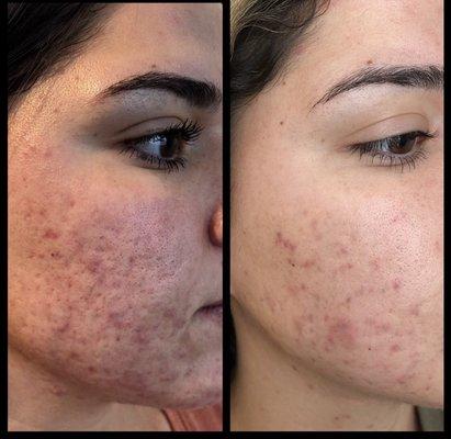 Before and after a 3 month series of Blackout Laser Peels