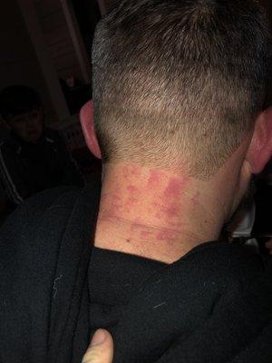 Razor burn on neck.