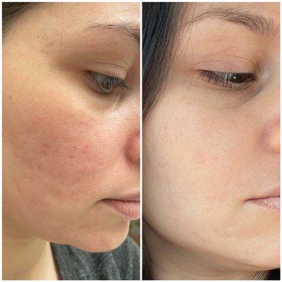 Before and After Acne Scar Correction