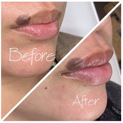 1ML Hyaluronic Acid Lip Filler  Natural Plump, Instant results, No downtime   Non-invasive, needle-less, Pain free