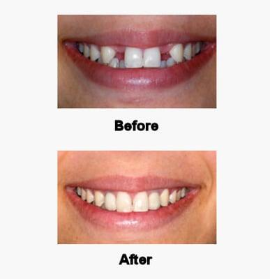 Dental implants tooth replacement