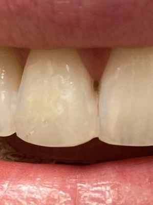 One of the sloppiest fixes I had -- dr glued the filling to the neighboring tooth , leaving me unable to floss teeth.