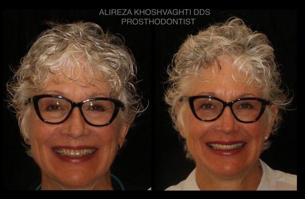 Full mouth rehabilitation. Smile makeover!