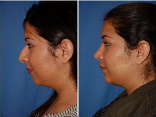 Rhinoplasty