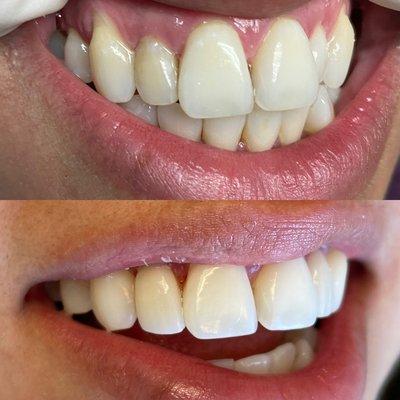 Prepless veneers