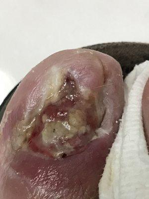 Infected toe!