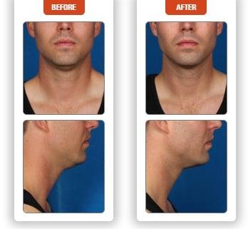 Kybella - Double Chin Fat Removal Injections (No Surgery). Great For Men & Women.