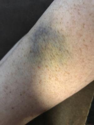 Bruising from blood draw