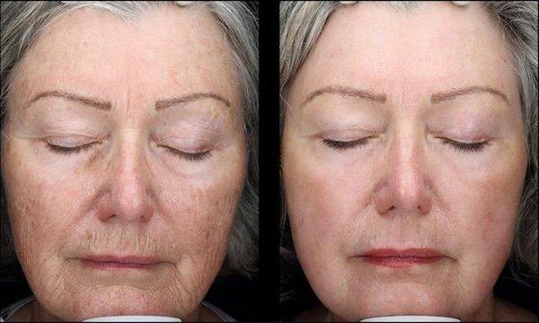 Profractional laser skin resurfacing. Before and After