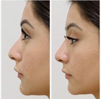 Non-surgical rhinoplasty.