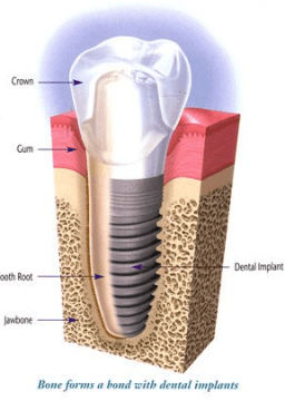 Implants are as common as fillings these days. We have in house specialty network that can provide comprehensive treatments.