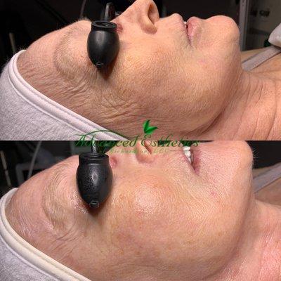 AntiAging Facial