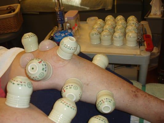 Cupping: Ceramic cups placed on body. Promotes circulation of energy and blood to relieve pain and expel toxins from the body.