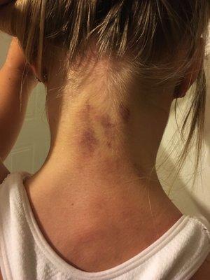 This is my daughters neck. This was taken 3 days after the massage session