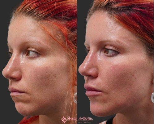 35 year old patient 1 week post 2ml of Juvederm filler injections for chin enhancement and augmentation