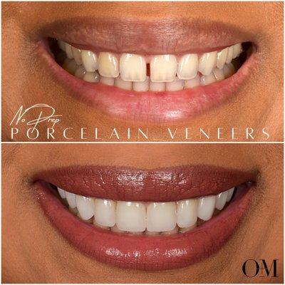 10 no prep porcelain veneers to improve brightness and proportion!