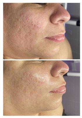 Before and After a Dermaplane glazed facial .