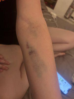 Bruised arms from blown out veins :)