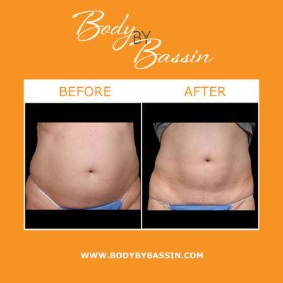 Laser fat removal can melt away unwanted fat. During this procedure, laser energy is delivered to the midsection, flanks, arms, & legs.