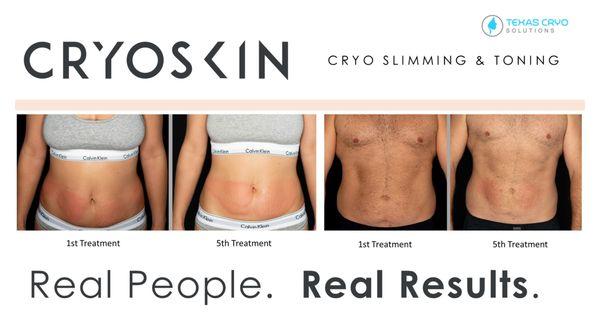 Cryo Solutions Frisco TX