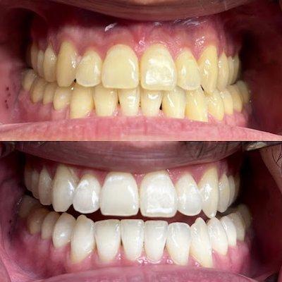 Professional in-office Teeth Whitening with amazing results