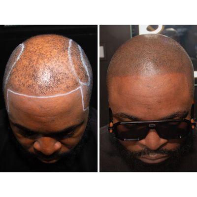 SMP Scalp Micropigmentation