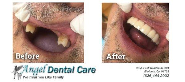 Before and After of dental implants and an actual patient photo from Angel Dental Care of El Monte.