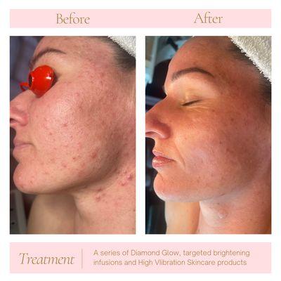 This beauty had 4 Acne Rescue / Diamond Glow treatments as well as targeted home care to get these amazing results!