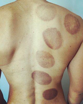 Cupping