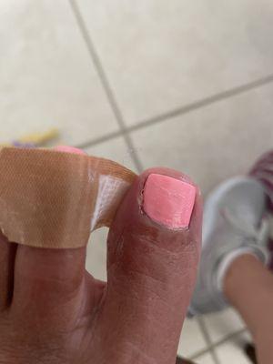 Painful toe