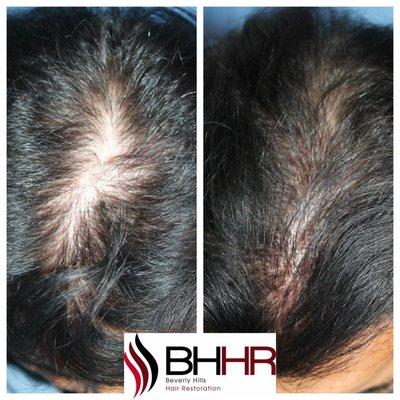 This is a before and after is just 4 months apart! Dr. Kahen is the pioneer in PRP hair restoration.