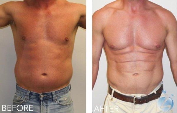 Vaser Liposuction