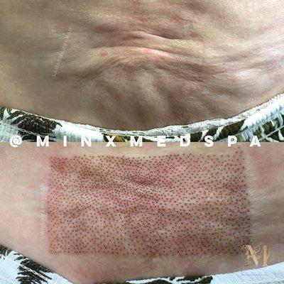 Skin Correction with Plasma Lift post Lipo! 
Immediate tightening and removal of skin folds on the abdomen post treatment.