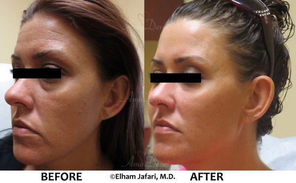 Liquid Facelift with combination of Botox/Dysport and filler injected in the temples, under the eyes, cheeks, and forehead.(Voluma/Volbella)