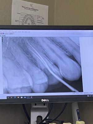 Perfect root canal fill placement!