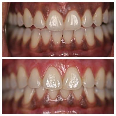 Gum Whitening/ Gum Bleaching