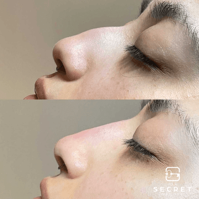 Non-Surgical Nose Job