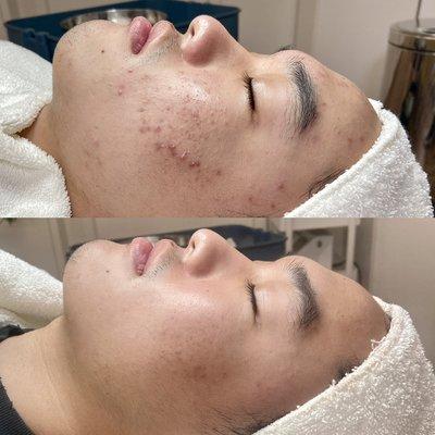 Before and after Acne Program