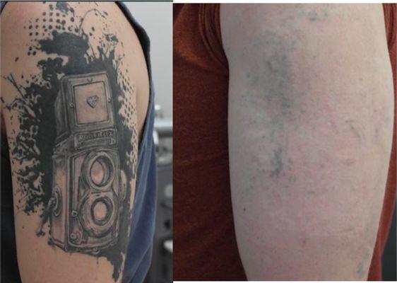 6 Candela Picoway Laser treatments, almost gone! 5 Year old tattoo