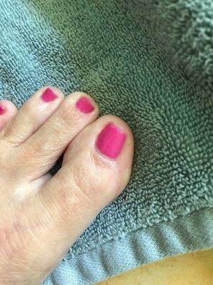 So Happy - big toe nail after Dr. Steve Walker fixed it on both sides!