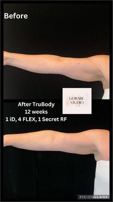 Before and after arms treatment. Nonsurgical body contouring