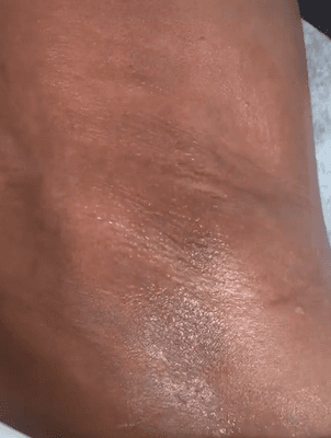 Armpit waxing results