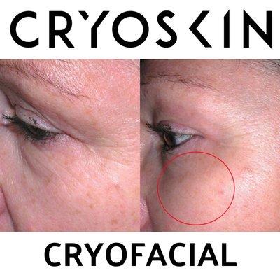 Cryskin Facial Uplift softening wrinkles