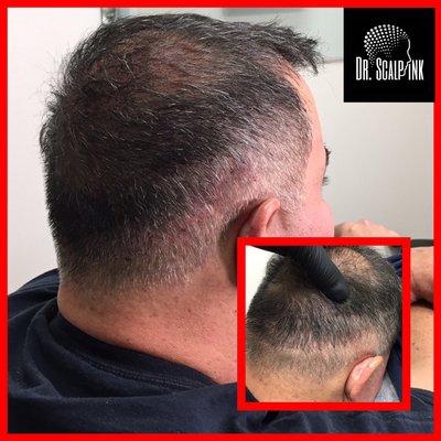 Hair transplant coverage using scalp micro pigmentation