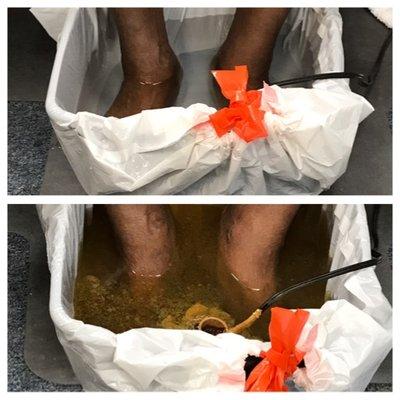 Before and After Foot Soak