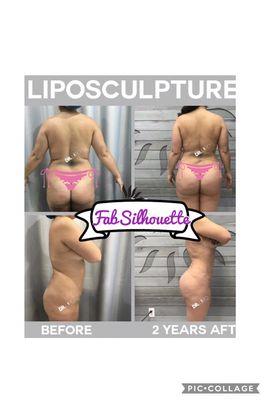 Liposculpture Specialists - You will look even better after our post op services.