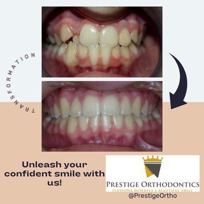 Crowdings and crossbite treated without extractions.