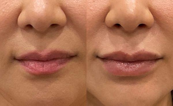 We specialize in natural looking lip filler results.  We're SCV's lip filler specialiasts.  Give us a call at 661-259-8100 for more info